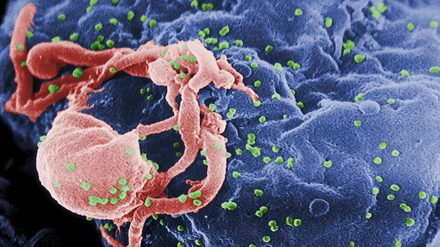 SIDA: Le VIH a 30 ans